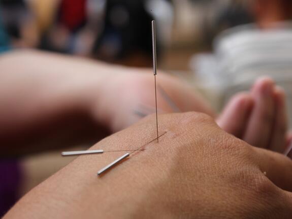 Acupuncture needles in hand